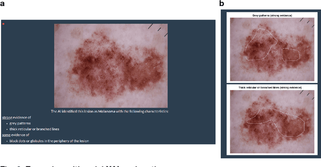 Figure 2 for Dermatologist-like explainable AI enhances trust and confidence in diagnosing melanoma