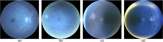 Figure 1 for A CNN-LSTM Combination Network for Cataract Detection using Eye Fundus Images