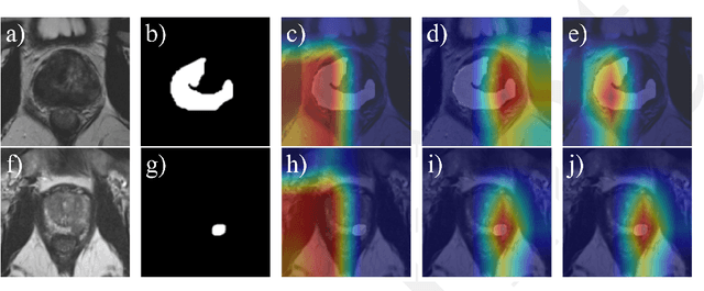 Figure 4 for Causality-Driven One-Shot Learning for Prostate Cancer Grading from MRI