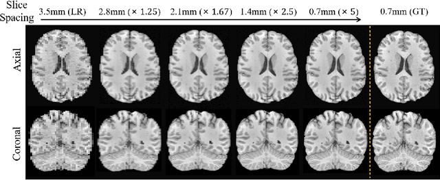 Figure 1 for Arbitrary Reduction of MRI Inter-slice Spacing Using Hierarchical Feature Conditional Diffusion