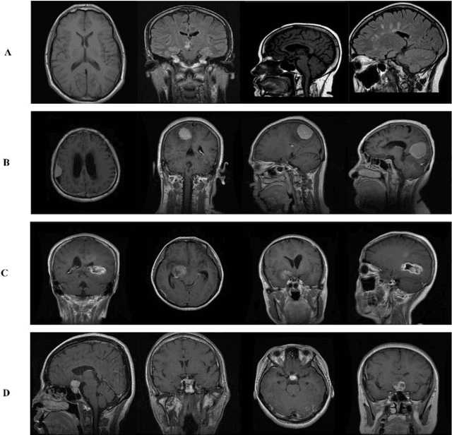 Figure 3 for Brain Tumor MRI Classification using a Novel Deep Residual and Regional CNN