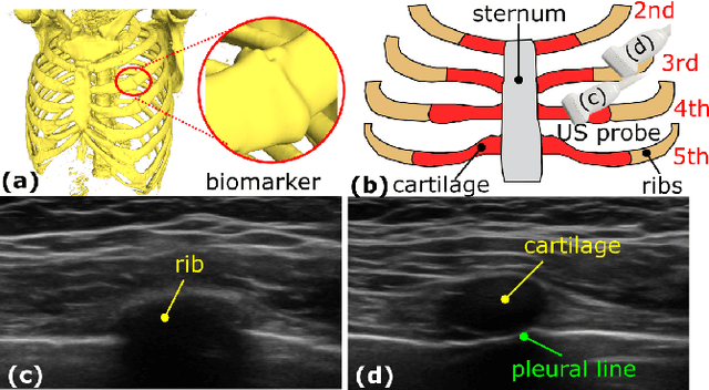 Figure 1 for Thoracic Cartilage Ultrasound-CT Registration using Dense Skeleton Graph