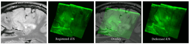Figure 1 for Dense Error Map Estimation for MRI-Ultrasound Registration in Brain Tumor Surgery Using Swin UNETR