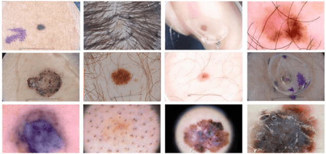 Figure 1 for UCM-Net: A Lightweight and Efficient Solution for Skin Lesion Segmentation using MLP and CNN
