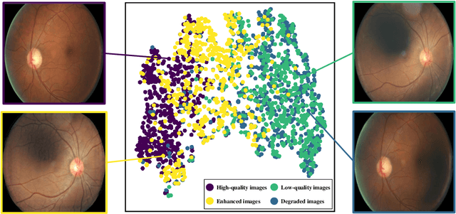 Figure 1 for Learning Enhancement From Degradation: A Diffusion Model For Fundus Image Enhancement