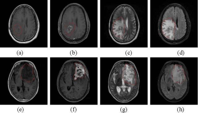 Figure 2 for Brain Tumor Recurrence vs. Radiation Necrosis Classification and Patient Survivability Prediction