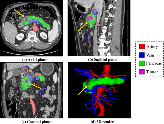 Figure 1 for Automated Peripancreatic Vessel Segmentation and Labeling Based on Iterative Trunk Growth and Weakly Supervised Mechanism