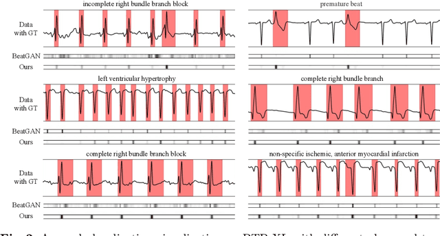 Figure 3 for Multi-scale Cross-restoration Framework for Electrocardiogram Anomaly Detection