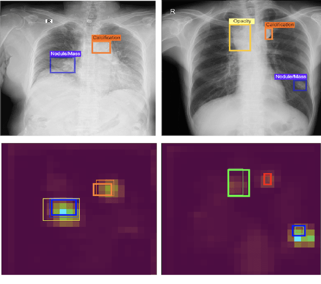 Figure 1 for Evaluating the impact of an explainable machine learning system on the interobserver agreement in chest radiograph interpretation