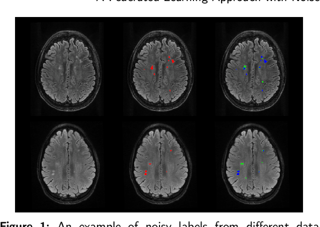 Figure 1 for Improving Multiple Sclerosis Lesion Segmentation Across Clinical Sites: A Federated Learning Approach with Noise-Resilient Training