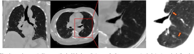 Figure 2 for MedSyn: Text-guided Anatomy-aware Synthesis of High-Fidelity 3D CT Images