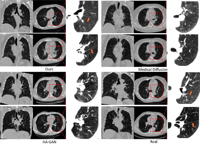 Figure 4 for MedSyn: Text-guided Anatomy-aware Synthesis of High-Fidelity 3D CT Images