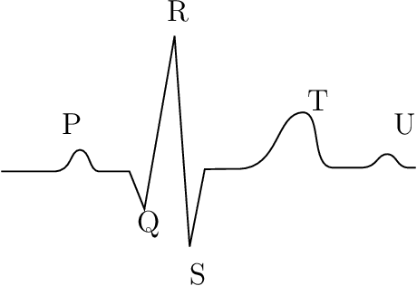Figure 1 for An Arrhythmia Classification-Guided Segmentation Model for Electrocardiogram Delineation