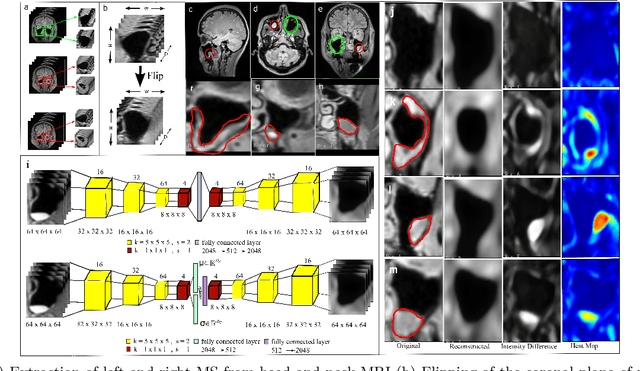 Figure 1 for Unsupervised Anomaly Detection of Paranasal Anomalies in the Maxillary Sinus