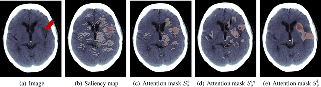 Figure 3 for ACAT: Adversarial Counterfactual Attention for Classification and Detection in Medical Imaging