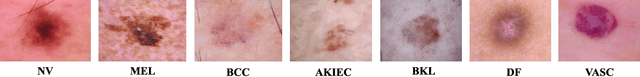 Figure 1 for Attention-Driven Lightweight Model for Pigmented Skin Lesion Detection