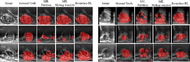 Figure 3 for Boundary-RL: Reinforcement Learning for Weakly-Supervised Prostate Segmentation in TRUS Images