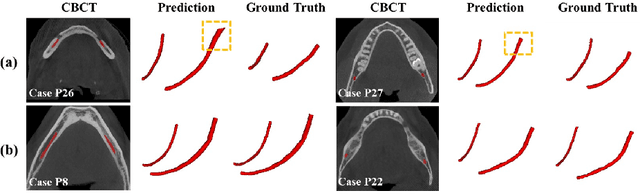 Figure 3 for Inferior Alveolar Nerve Segmentation in CBCT images using Connectivity-Based Selective Re-training