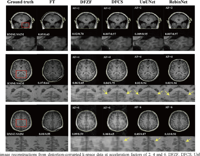 Figure 4 for Image Reconstruction with B0 Inhomogeneity using an Interpretable Deep Unrolled Network on an Open-bore MRI-Linac