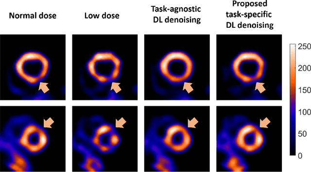 Figure 4 for A task-specific deep-learning-based denoising approach for myocardial perfusion SPECT