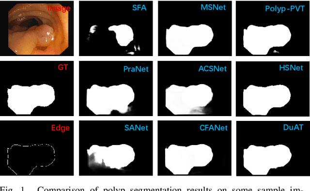 Figure 1 for A Survey on Deep Learning for Polyp Segmentation: Techniques, Challenges and Future Trends