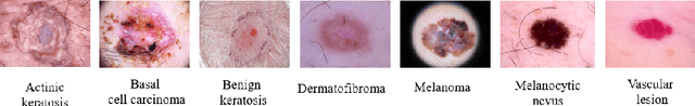 Figure 1 for Deep Learning based Novel Cascaded Approach for Skin Lesion Analysis