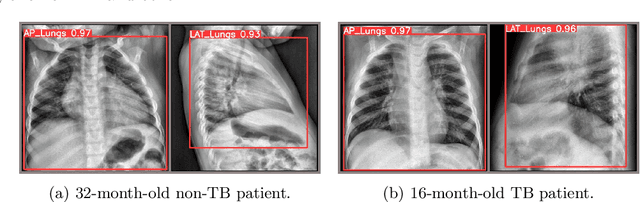 Figure 3 for Deep learning-based lung segmentation and automatic regional template in chest X-ray images for pediatric tuberculosis