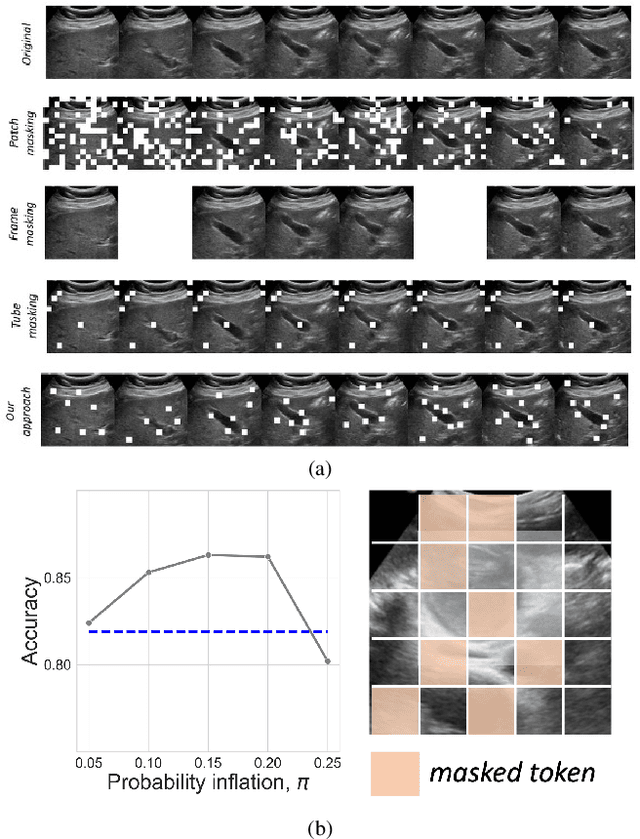 Figure 1 for FocusMAE: Gallbladder Cancer Detection from Ultrasound Videos with Focused Masked Autoencoders