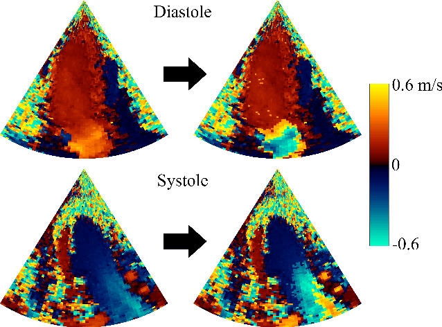 Figure 2 for Phase Unwrapping of Color Doppler Echocardiography using Deep Learning