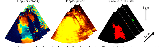 Figure 3 for Phase Unwrapping of Color Doppler Echocardiography using Deep Learning