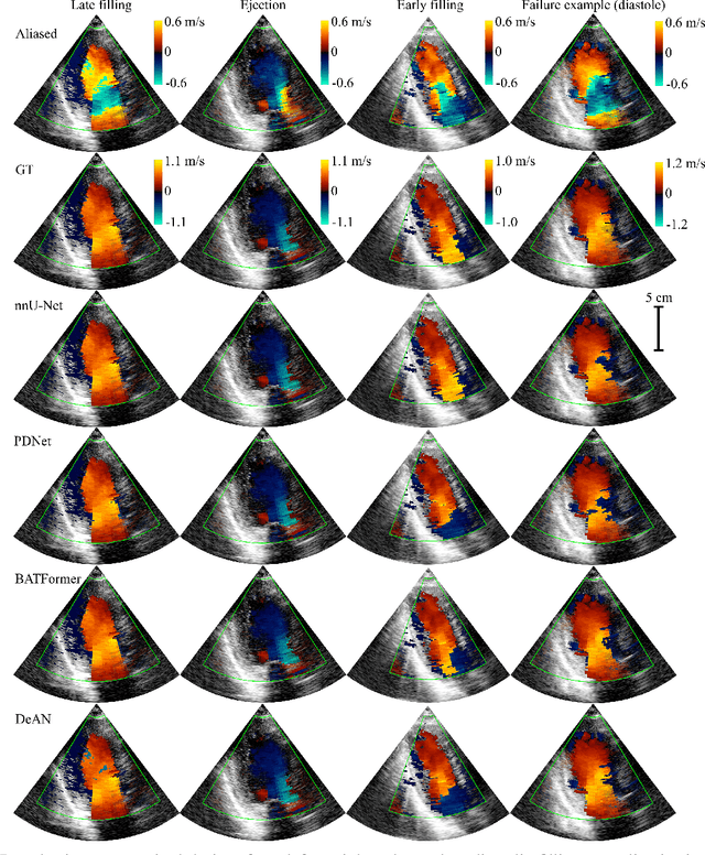 Figure 4 for Phase Unwrapping of Color Doppler Echocardiography using Deep Learning