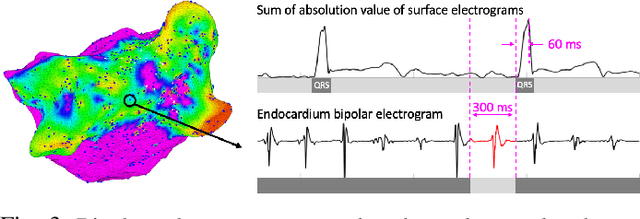 Figure 3 for Electroanatomic Mapping to determine Scar Regions in patients with Atrial Fibrillation