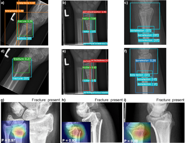 Figure 3 for DeepLOC: Deep Learning-based Bone Pathology Localization and Classification in Wrist X-ray Images