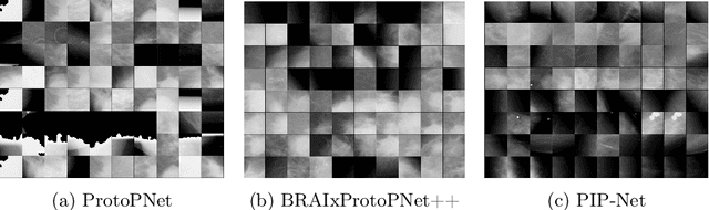 Figure 2 for Prototype-based Interpretable Breast Cancer Prediction Models: Analysis and Challenges