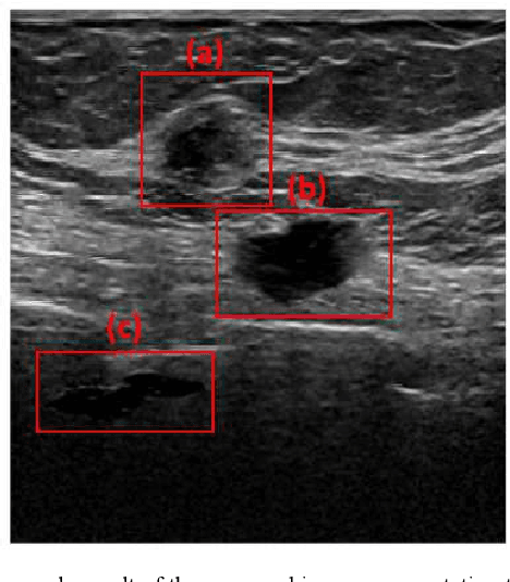 Figure 2 for Copy-Paste Image Augmentation with Poisson Image Editing for Ultrasound Instance Segmentation Learning