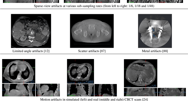 Figure 4 for Artifact Reduction in 3D and 4D Cone-beam Computed Tomography Images with Deep Learning -- A Review