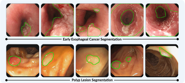 Figure 1 for Single-Image-Based Deep Learning for Segmentation of Early Esophageal Cancer Lesions
