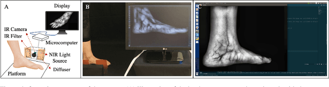 Figure 4 for Real-Time Superficial Vein Imaging System for Observing Abnormalities on Vascular Structures