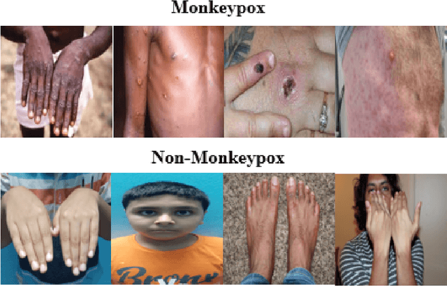 Figure 1 for Transfer learning and Local interpretable model agnostic based visual approach in Monkeypox Disease Detection and Classification: A Deep Learning insights