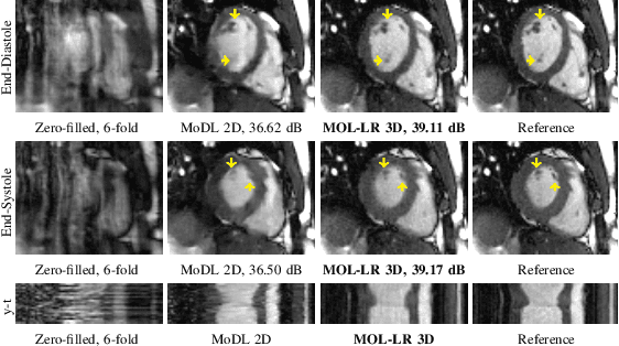 Figure 2 for Accelerated parallel MRI using memory efficient and robust monotone operator learning (MOL)