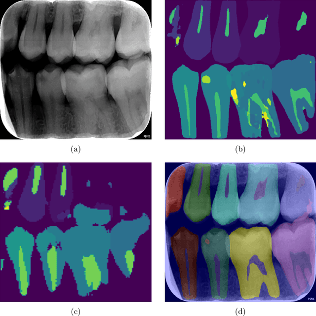 Figure 4 for Radious: Unveiling the Enigma of Dental Radiology with BEIT Adaptor and Mask2Former in Semantic Segmentation