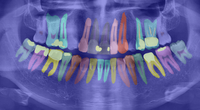 Figure 3 for Radious: Unveiling the Enigma of Dental Radiology with BEIT Adaptor and Mask2Former in Semantic Segmentation