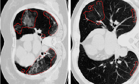 Figure 1 for DECOR-NET: A COVID-19 Lung Infection Segmentation Network Improved by Emphasizing Low-level Features and Decorrelating Features