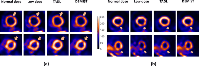 Figure 4 for DEMIST: A deep-learning-based task-specific denoising approach for myocardial perfusion SPECT