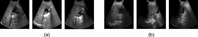 Figure 1 for Gall Bladder Cancer Detection from US Images with Only Image Level Labels