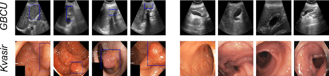Figure 3 for Gall Bladder Cancer Detection from US Images with Only Image Level Labels