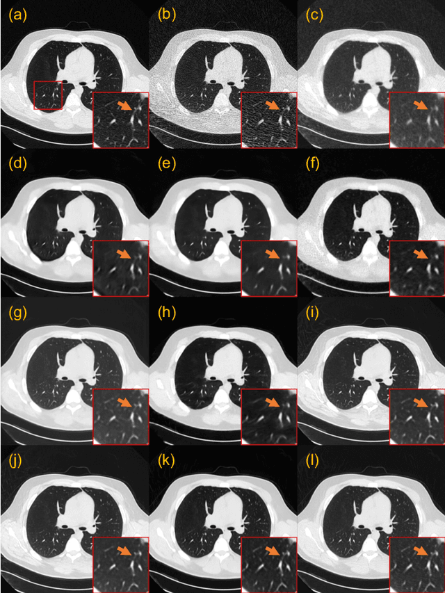 Figure 3 for CoreDiff: Contextual Error-Modulated Generalized Diffusion Model for Low-Dose CT Denoising and Generalization