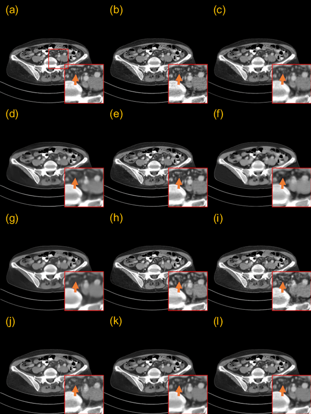 Figure 4 for CoreDiff: Contextual Error-Modulated Generalized Diffusion Model for Low-Dose CT Denoising and Generalization