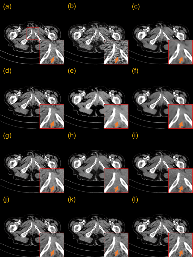 Figure 2 for CoreDiff: Contextual Error-Modulated Generalized Diffusion Model for Low-Dose CT Denoising and Generalization