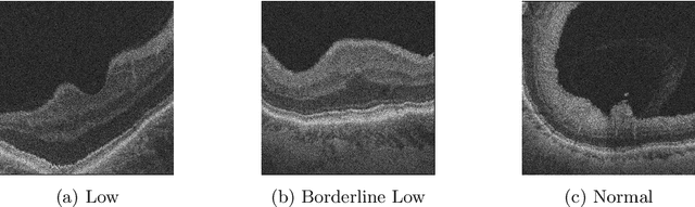 Figure 1 for JointViT: Modeling Oxygen Saturation Levels with Joint Supervision on Long-Tailed OCTA